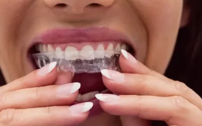 Invisalign Hollywood: Clear Aligner Therapy for Discreet Orthodontic Correction